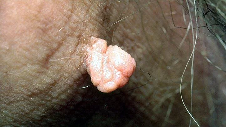 쥐젖 제거방법 5가지 집에서 쉽게 해결하는 꿀팁