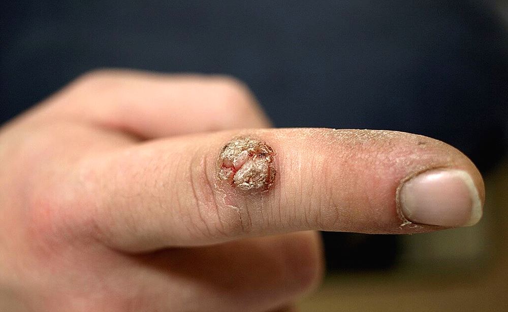 사마귀 제거 방법, 피부과 가지 않고 해결하는 법